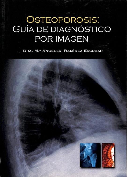 OSTEOPOROSIS GUIA DE DIAGNOSTICO POR IMAGEN | M ANGELES RAMIREZ ESCOBAR