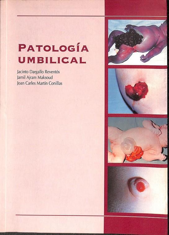 PATOLOGIA UMBILICAL  | JACINTO DARGALLO JAMIL ARJAM JOAN CARLES MARTIN